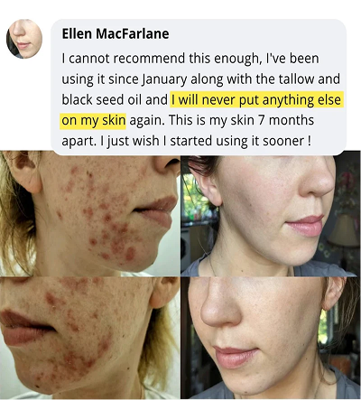 Skin transformation review from Ellen