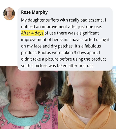 Skin transformation review from Rose