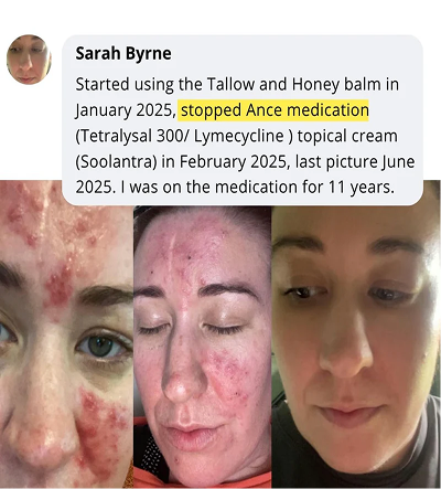 Skin transformation review from Sarah